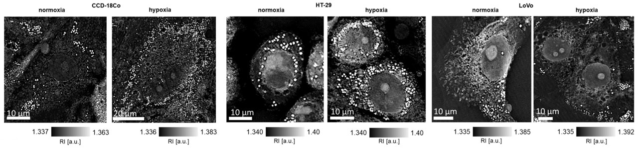 Nanolive imaging was used to detect changes in lipid droplet volume under hypoxic conditions